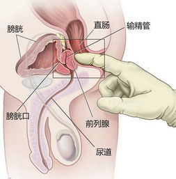 前列腺自我按摩方法有哪些