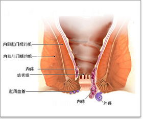 外痔瘡怎么治最快方法有哪些方法有哪些