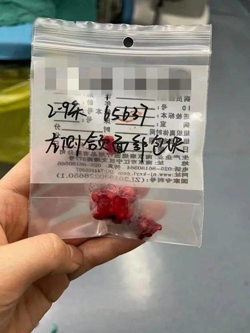 腮腺瘤術中注意事項