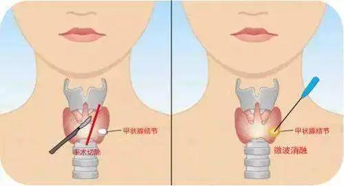 甲狀腺結(jié)節(jié)注意事項(xiàng),甲狀腺結(jié)節(jié)的飲食方面應(yīng)注意事項(xiàng),甲狀腺結(jié)節(jié)患者飲食注意事項(xiàng)
