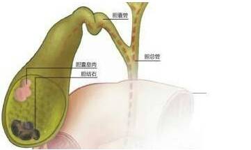 術(shù)前,注意事項(xiàng),膽囊息肉