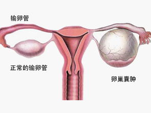 腹腔鏡卵巢囊腫手術(shù)后注意事項(xiàng)