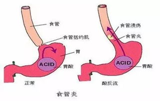 返流性食管炎注意事項(xiàng)