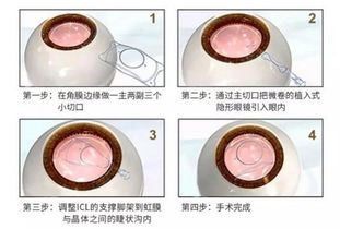 做高度近視手術(shù)術(shù)前注意事項(xiàng)