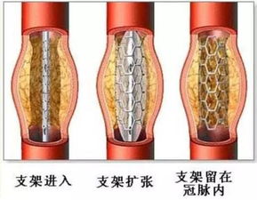 心臟血管狹窄注意事項(xiàng)