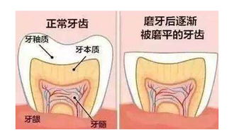 磨牙,注意事項(xiàng)