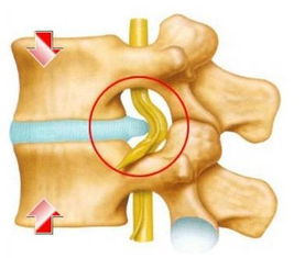 腰椎盤凸出注意事項(xiàng)