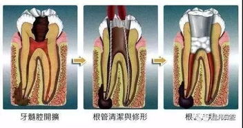 根管治療后樹脂補牙后注意事項