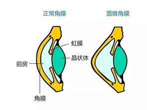 圓錐角膜術(shù)后注意事項(xiàng),圓錐角膜平時(shí)注意事項(xiàng),圓錐角膜配鏡注意事項(xiàng)