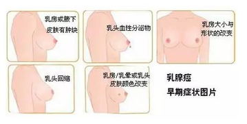 乳頭乳暈漂色注意事項