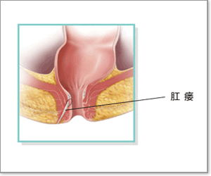 艾滋病可以做肛瘺手術嗎,艾滋病肛瘺去哪里手術,艾滋病肛瘺手術多久恢復