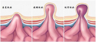 7歲小孩做疝氣手術(shù)注意事項(xiàng)