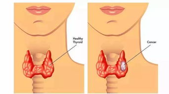甲狀腺結(jié)節(jié)要注意事項(xiàng)