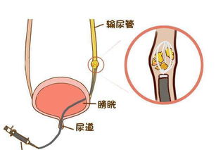 輸尿管插管后注意事項(xiàng)