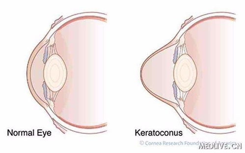 角膜,圓錐,注意事項(xiàng)