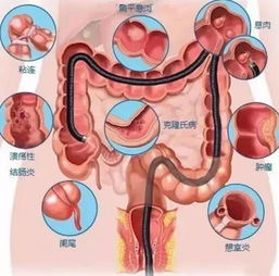 腸鏡檢查前注意事項(xiàng)有哪些,腸鏡檢查后注意事項(xiàng),胃鏡腸鏡檢查前后的注意事項(xiàng)有哪些?