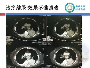 胸腔熱灌注的注意事項(xiàng),恩度胸腔灌注注意事項(xiàng),胸腔灌注化療注意事項(xiàng)