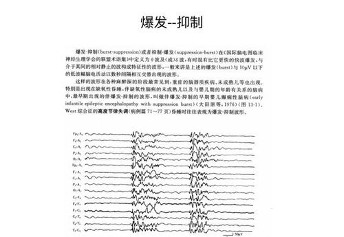 小兒腦電圖基礎(chǔ)知識課件