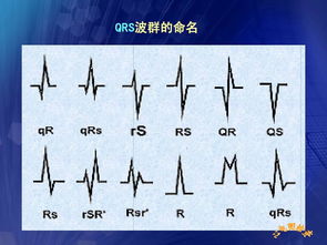 心電圖,基礎(chǔ)知識(shí),講解,PPT